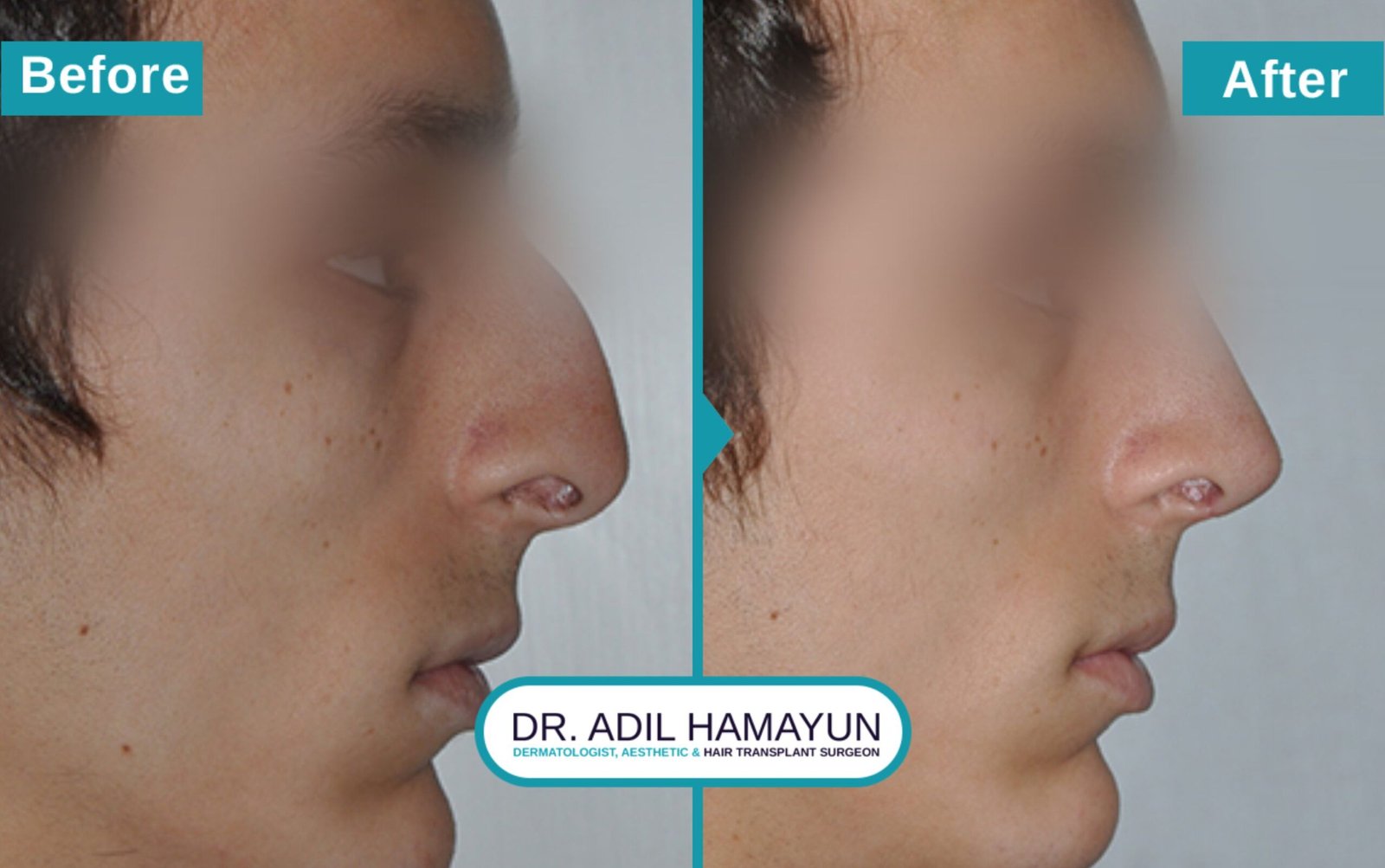Nose Correction