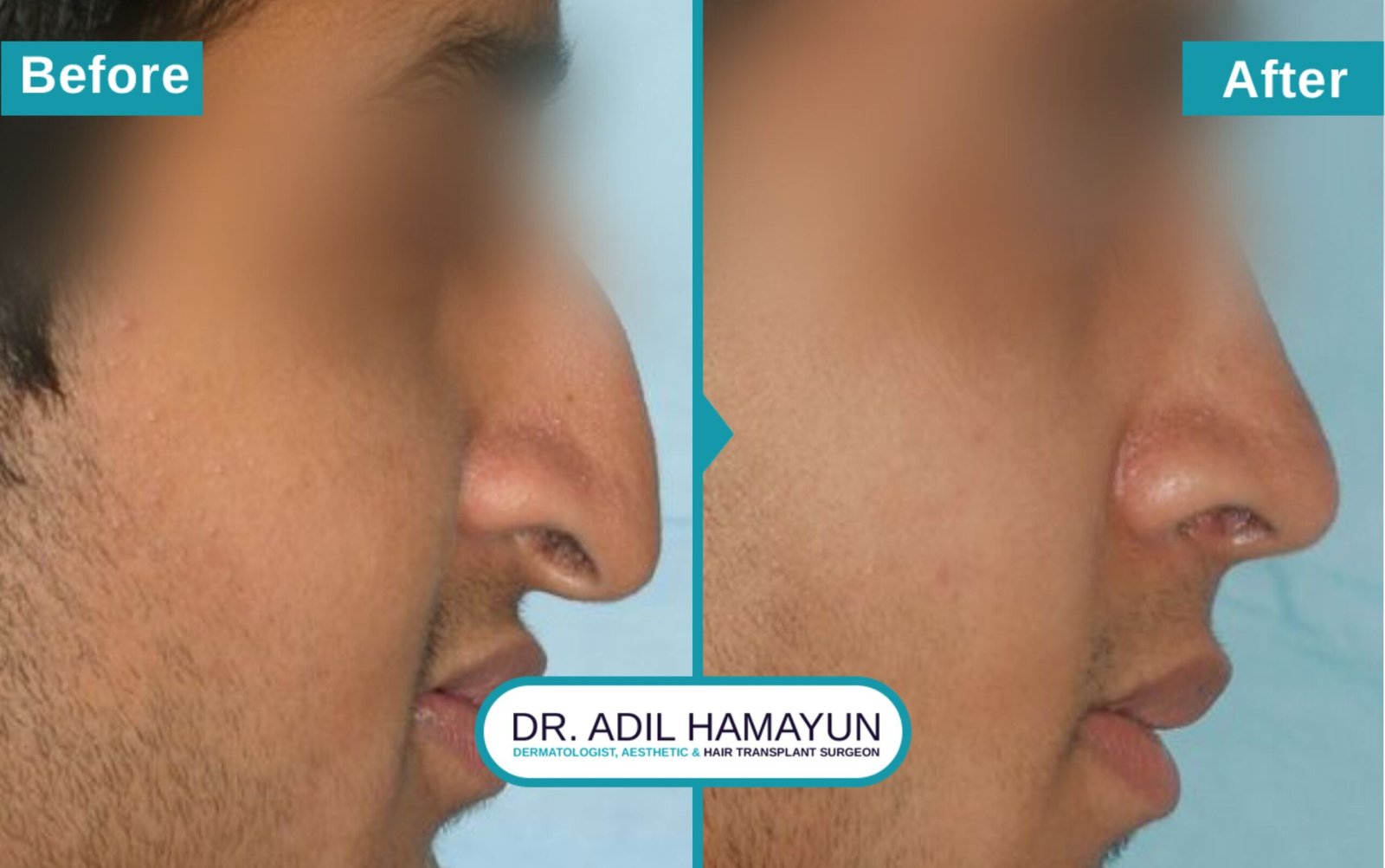 Nose Correction
