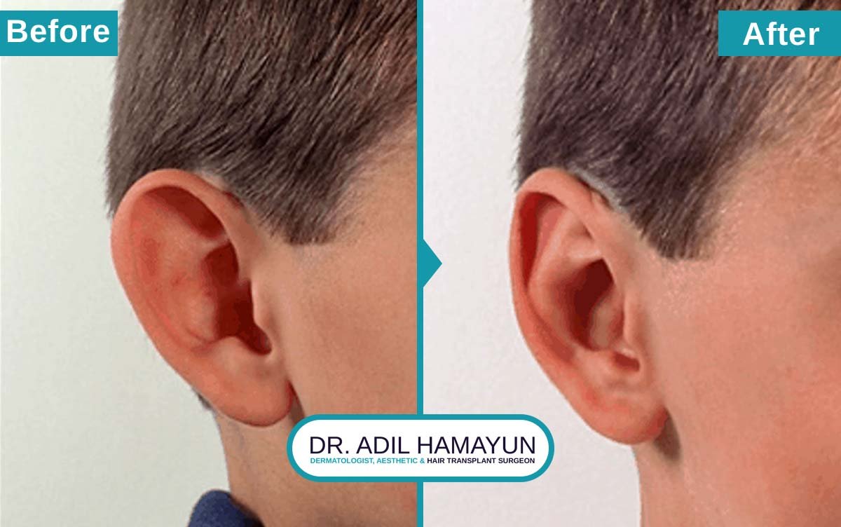 Ear Correction
