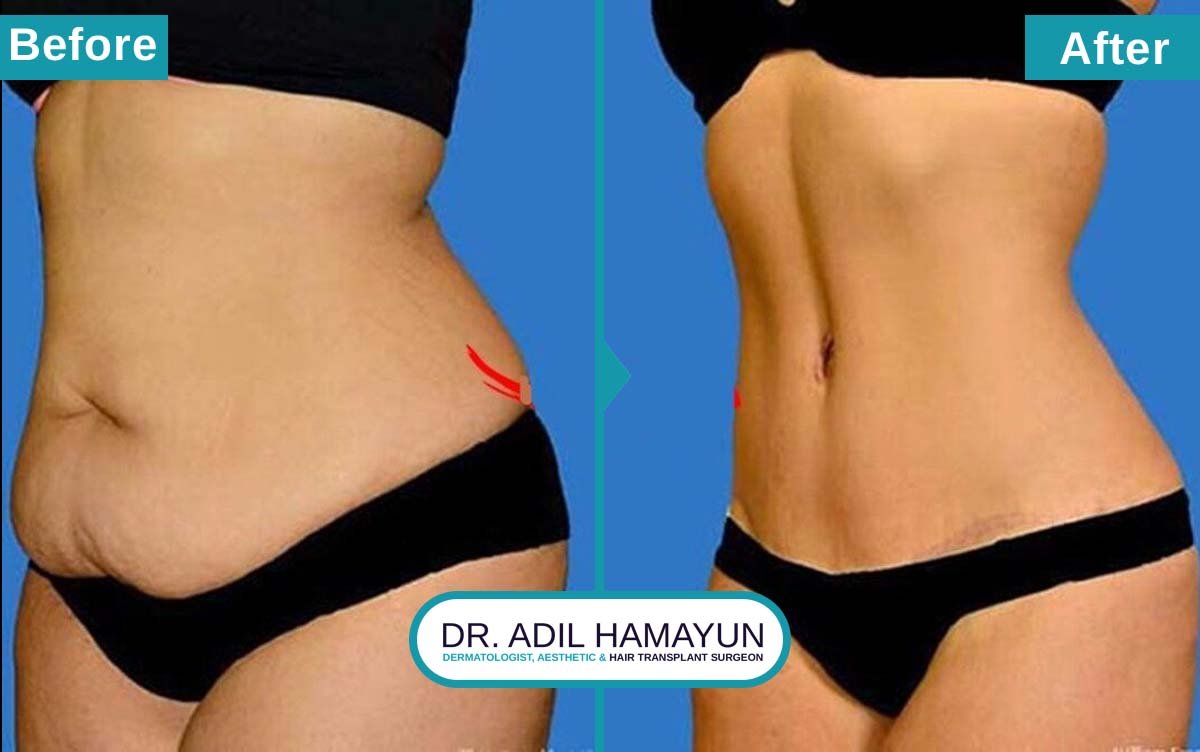 Liposuction